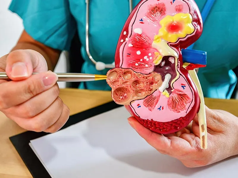 Anatomisches Nierenmodell in der Hand einer Ärztin